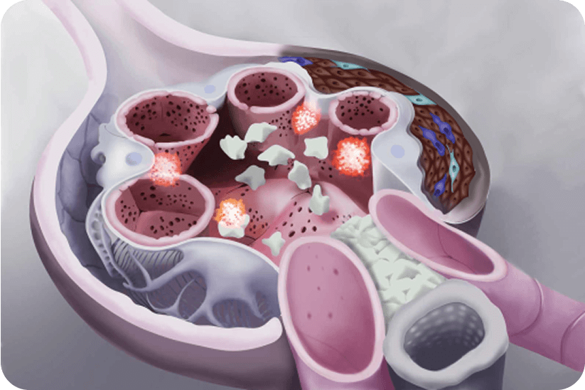Detailed glomerulus structure showing presence of crescents