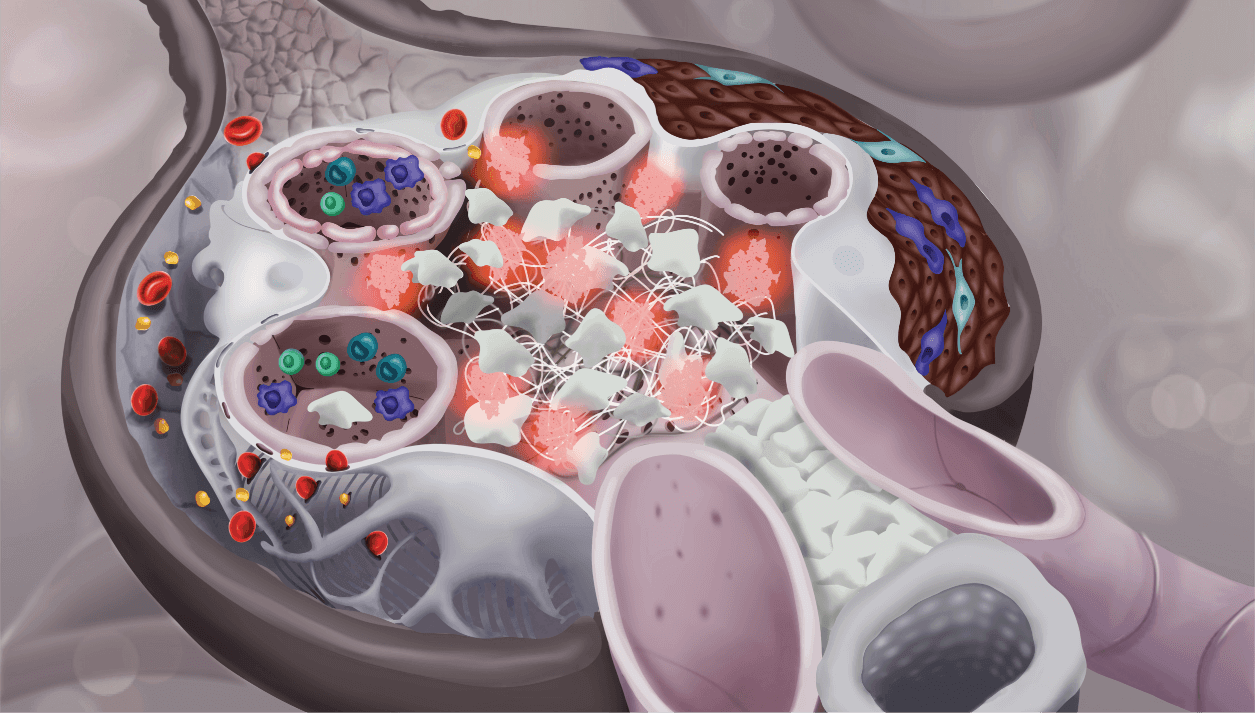 Glomerulus showing crescent formation, immune cells, and tubular atrophy