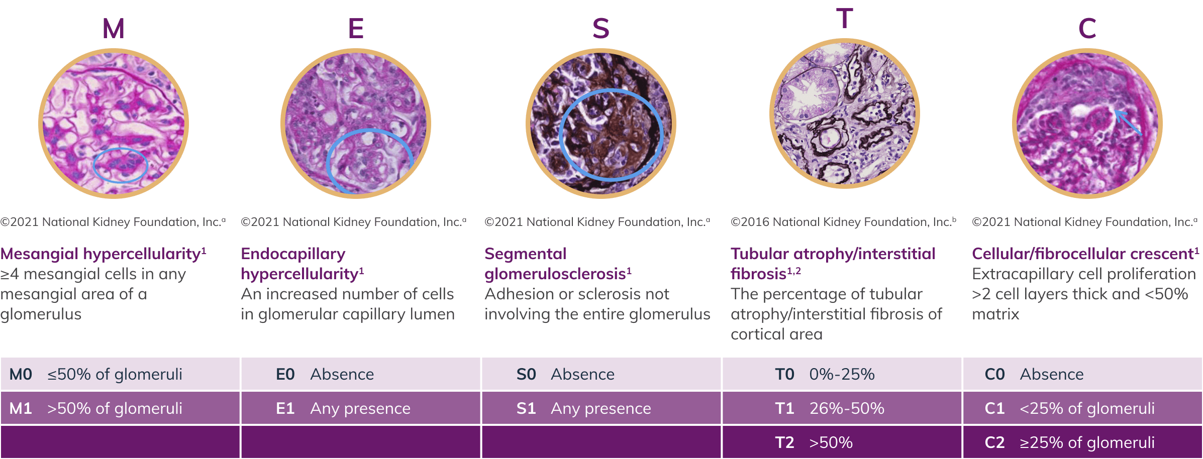 Histopathological classifications of IgA nephropathy displayed through microscopic images and descriptions of five key conditions