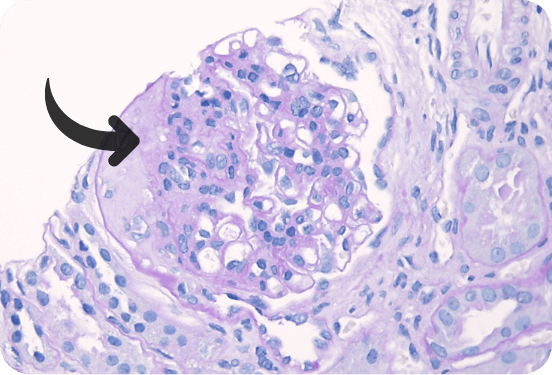 PAS staining showing sclerosis in the upper left portion of the glomerulus