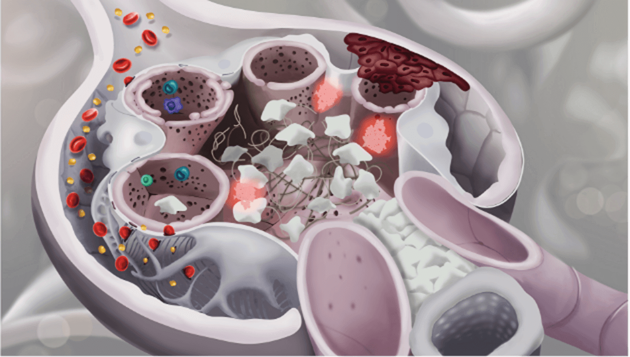 Detailed glomerulus structure with mesangial hypercellularity, endocapillary hypercellularity, and segmental sclerosis