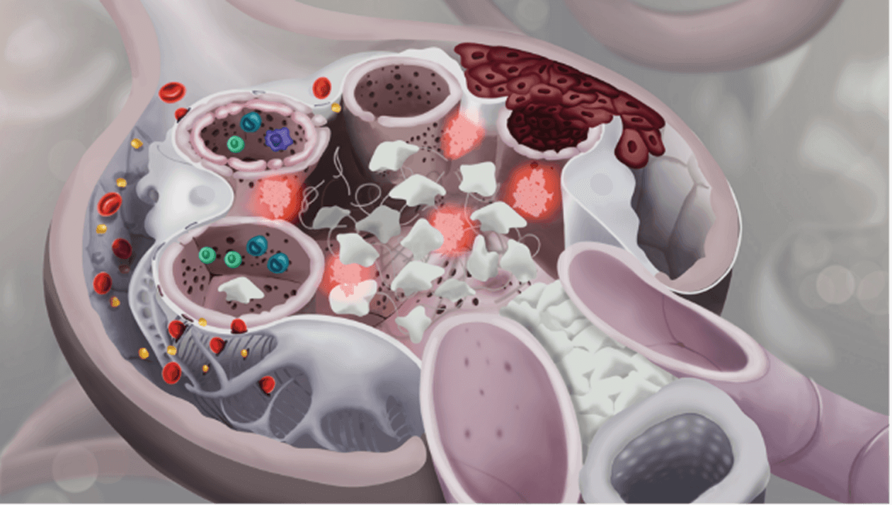 Detailed glomerulus structure with excess mesangial cells and immune cells