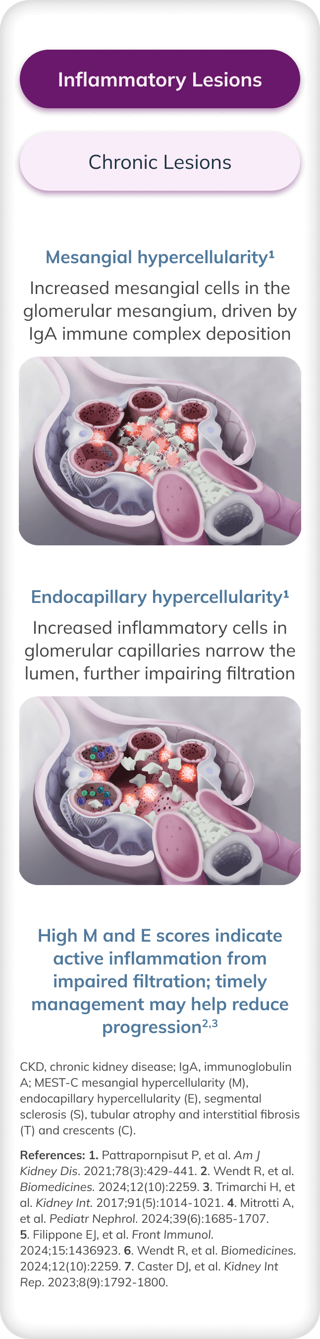 Illustration of inflammatory lesions (mesangial and endocapillary hypercellularity), impairing glomerular filtration.