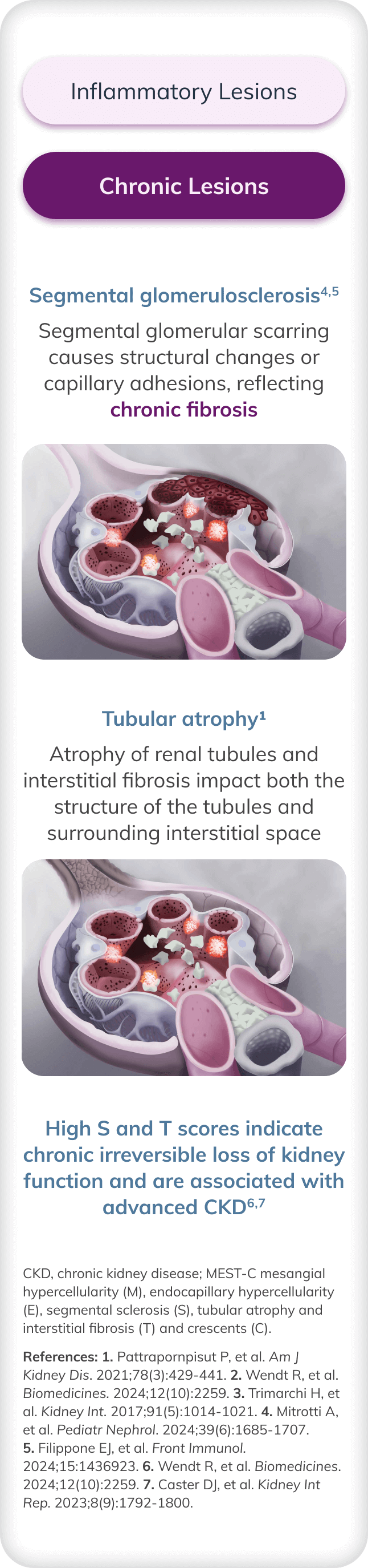 Illustration of chronic lesions (segmental glomerulosclerosis and tubular atrophy), indicating chronic irreversible loss of kidney function