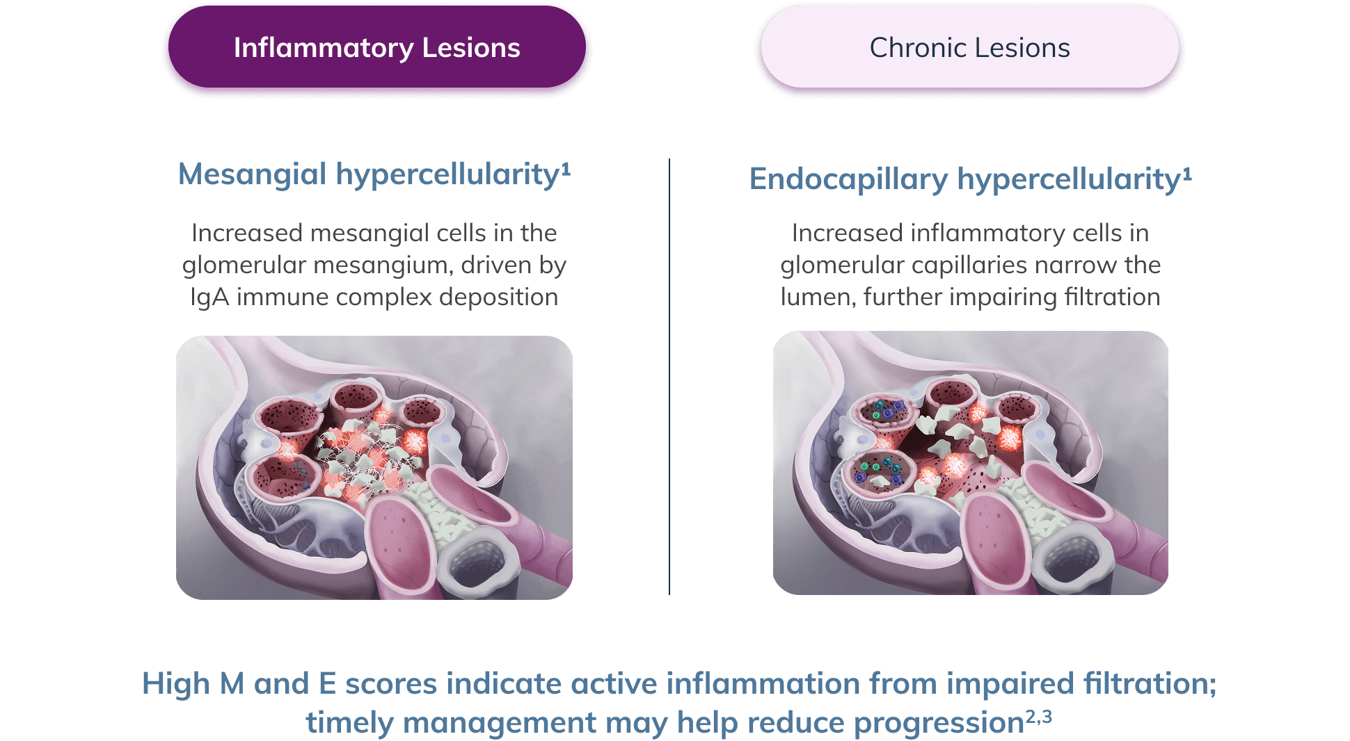 Illustration of inflammatory lesions (mesangial and endocapillary hypercellularity), impairing glomerular filtration.