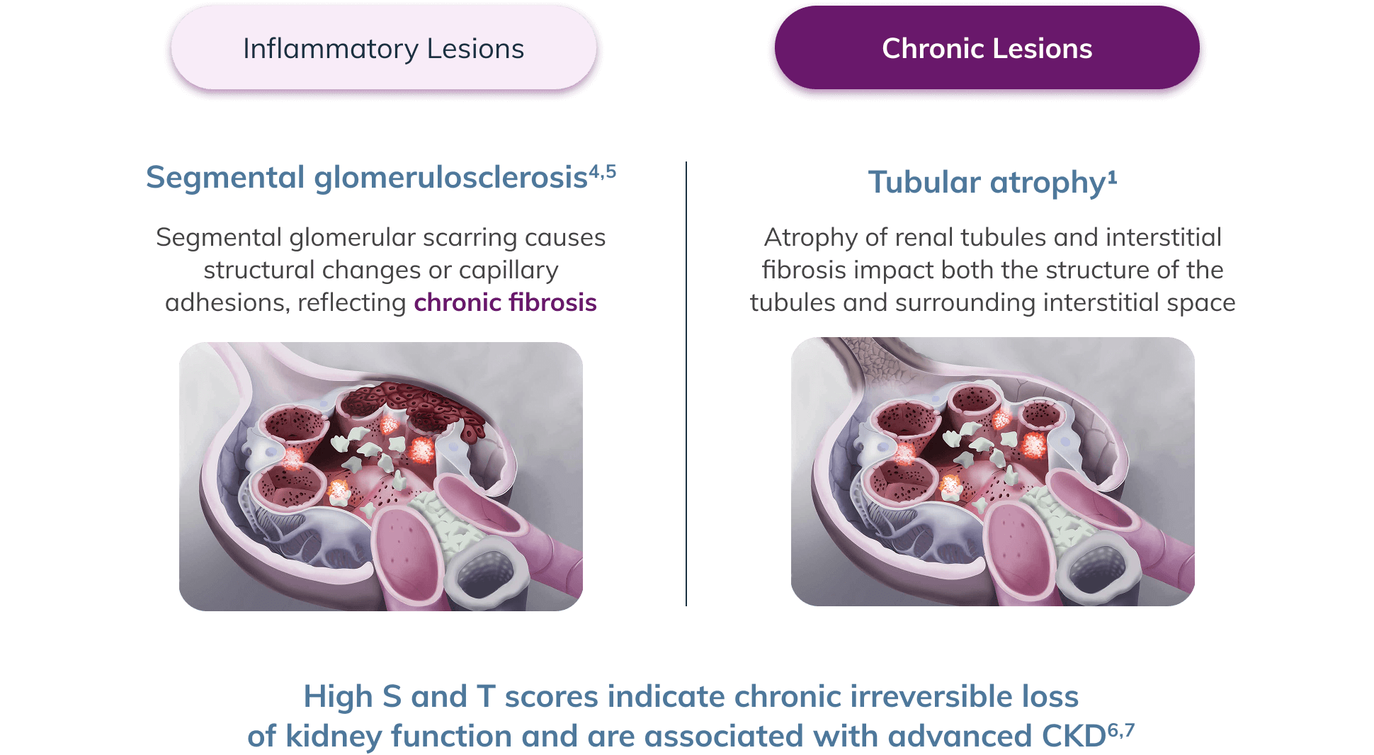 Illustration of chronic lesions (segmental glomerulosclerosis and tubular atrophy), indicating chronic irreversible loss of kidney function