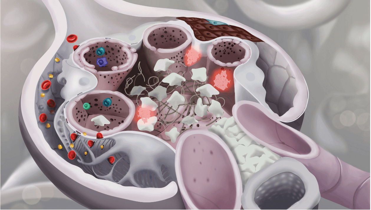 Detailed glomerulus structure showing crescent formation, mesangial cells and immune cells