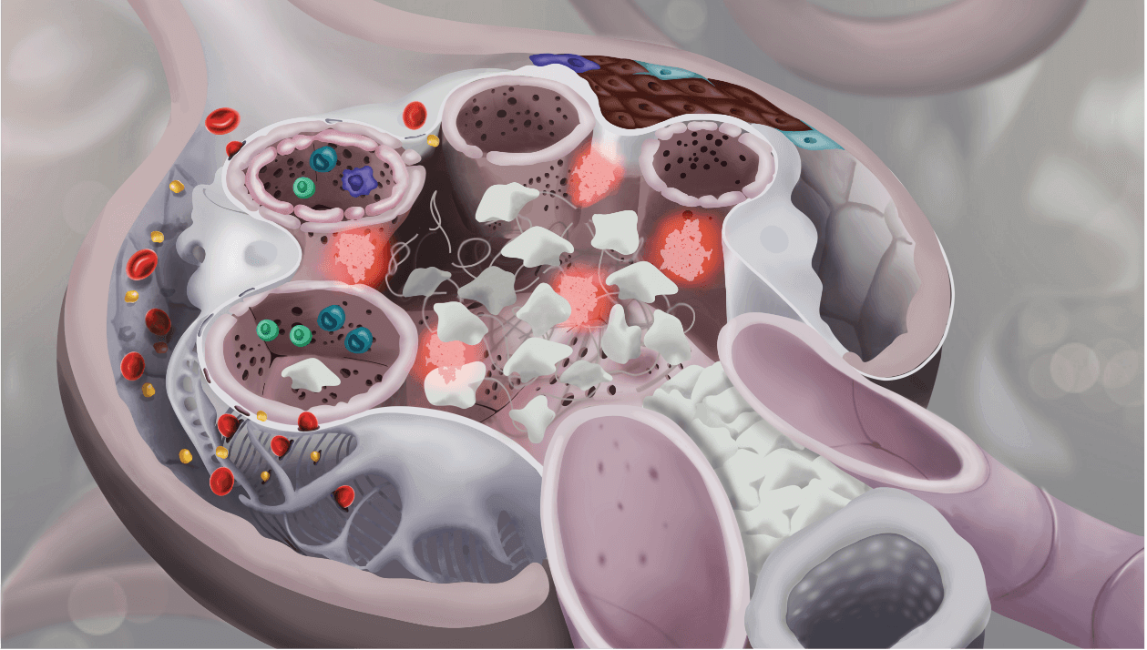 Detailed kidney structure showing crescent formation, mesangial cells and immune cells