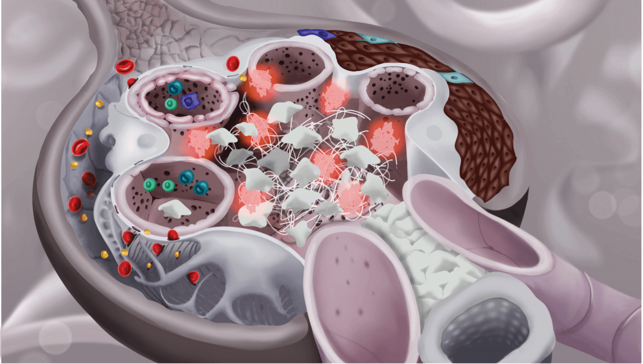 Glomerulus showing crescent formation, mesangial cells, and immune cells