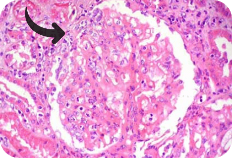 H&E stain showing mesangial hypercellularity, endocapillary hypercellularity, and crescent formation