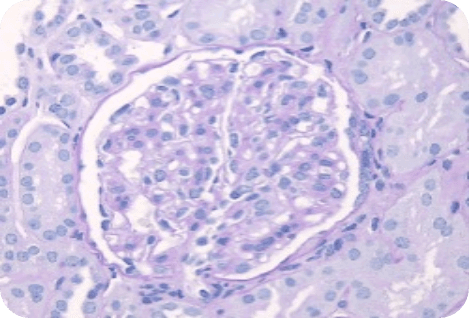 PAS staining of M1 positive lesion.